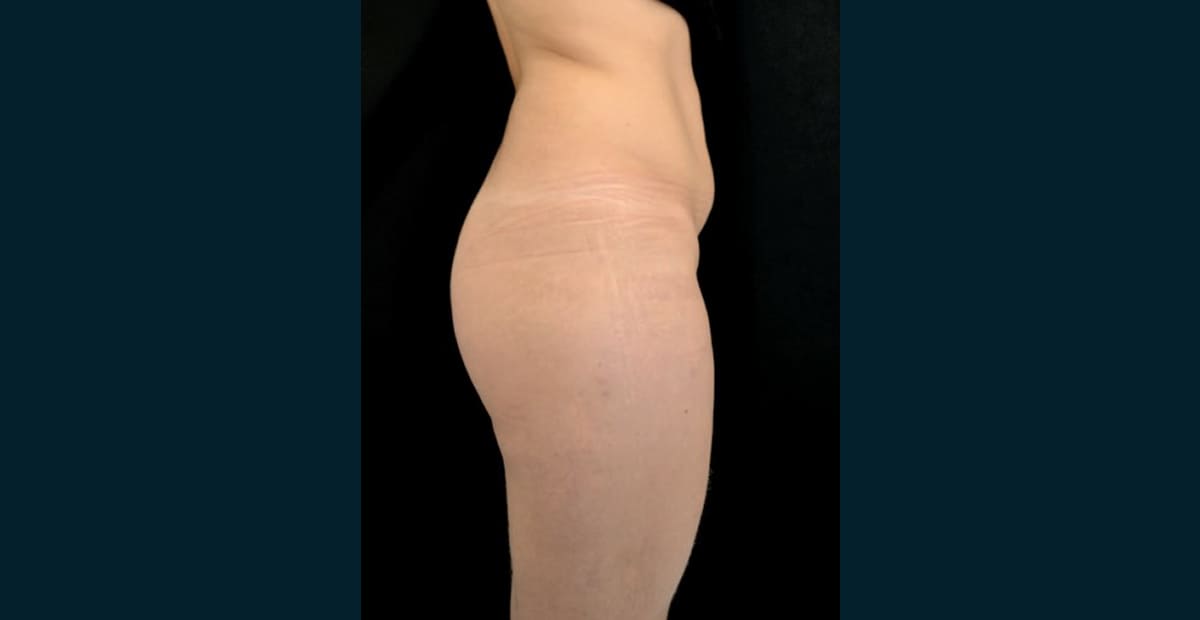 1-antes-aumento-de-gluteos