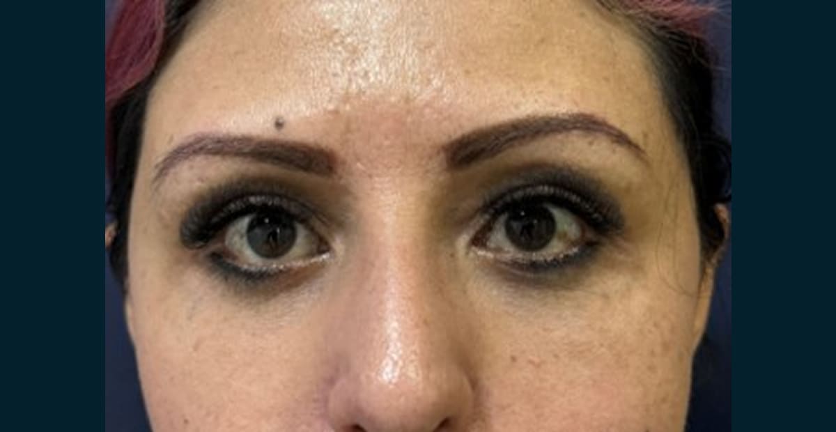 1-antes-bleforoplastia