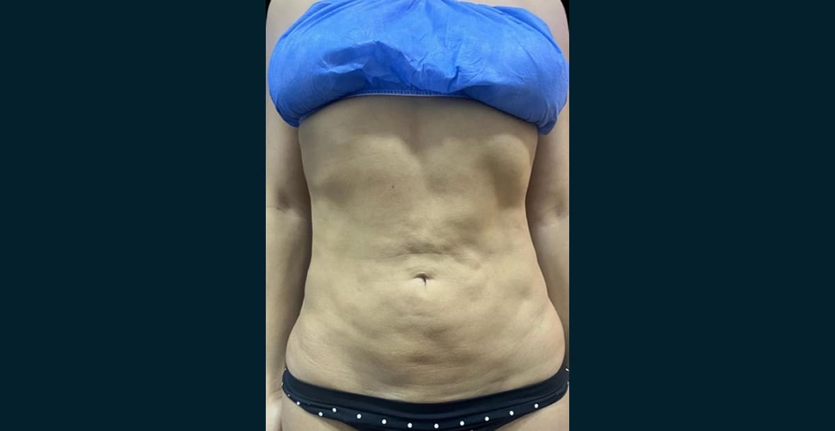 1-antes-bodytite