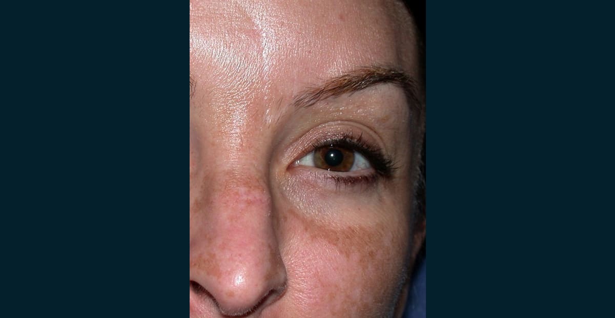 1-antes-clear-skin