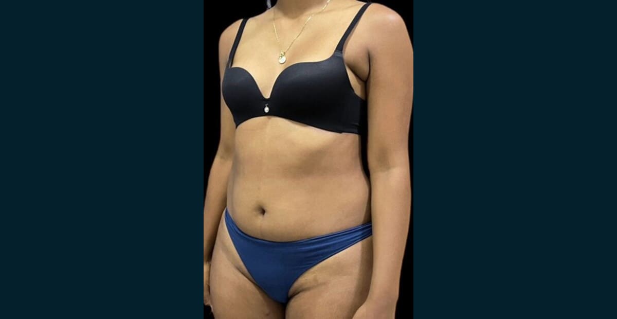 1-antes-liposuccion