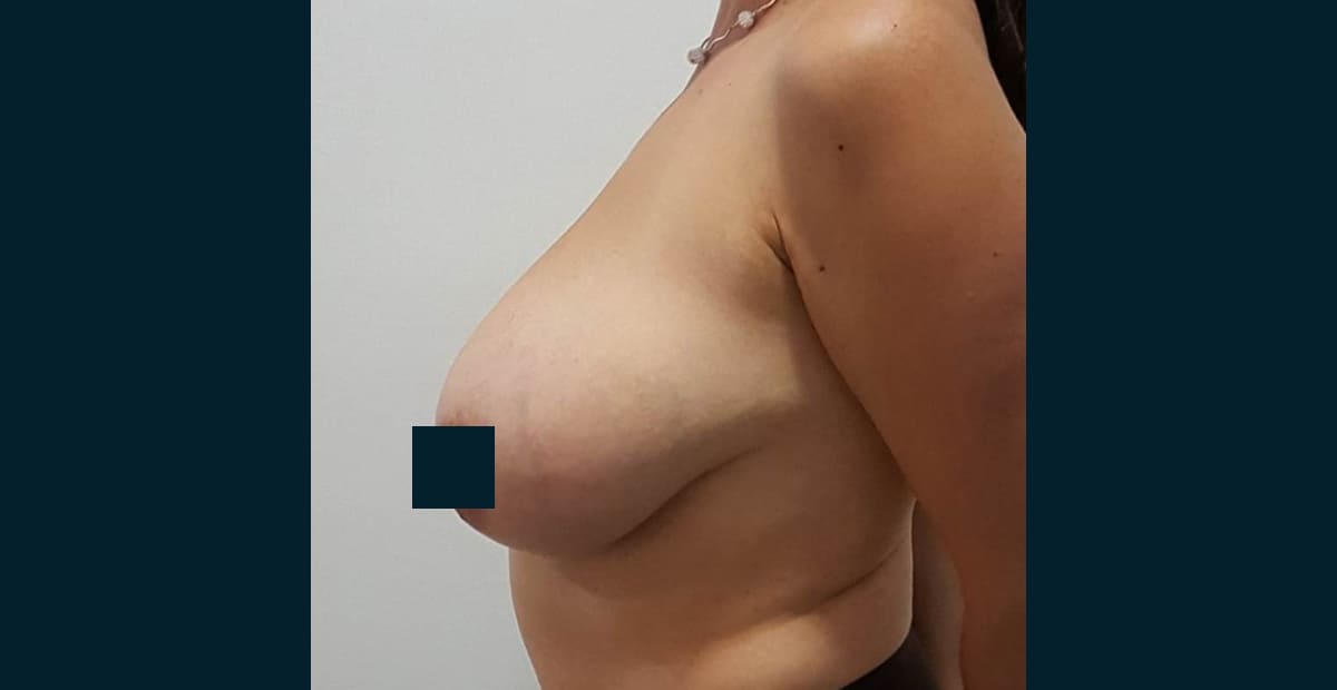 1-antes-mamoplastia-de-reduccion