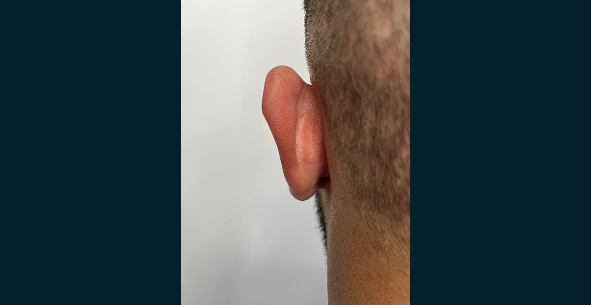 1-antes-otoplastia