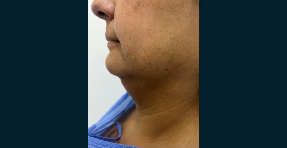 1-antes-perfilado-facial