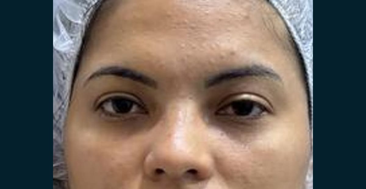 1-antes-pexia-de-cejas