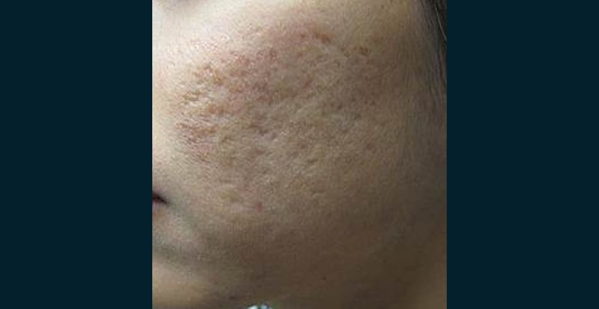 1-antes-secuelas-de-acne