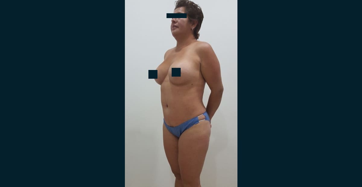 1-despues-abdominoplastia