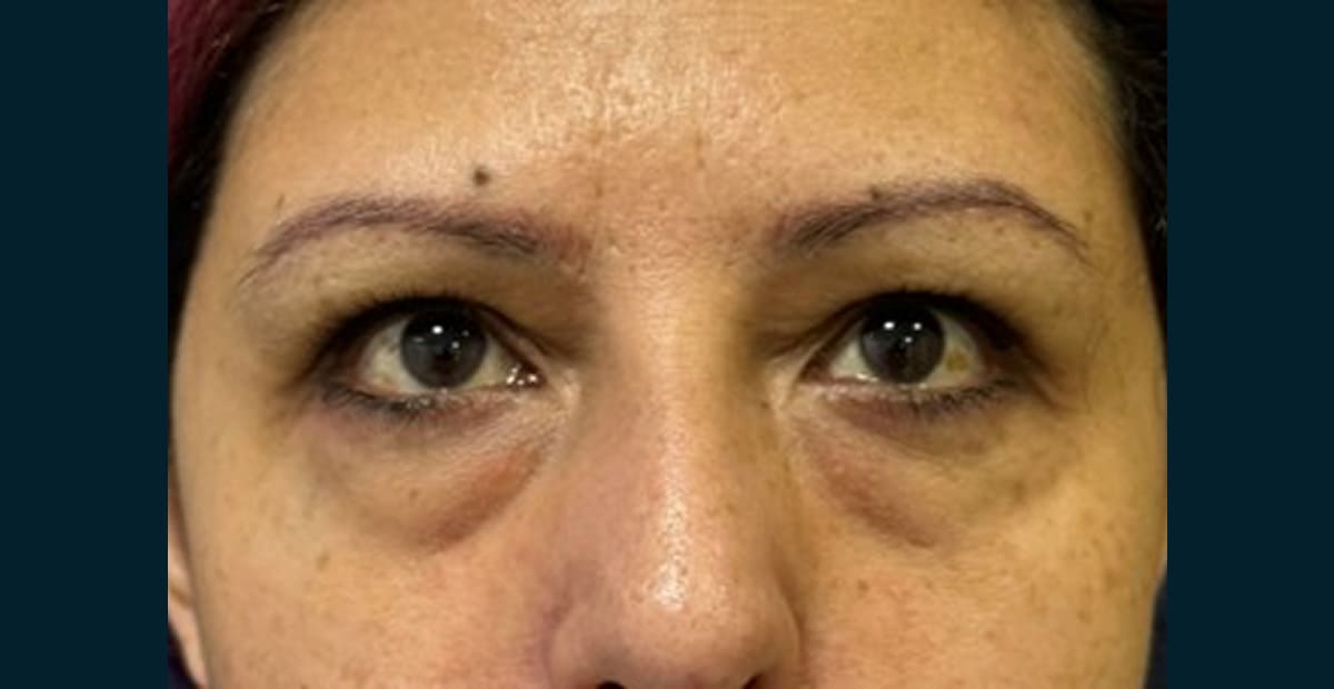 1-despues-bleforoplastia