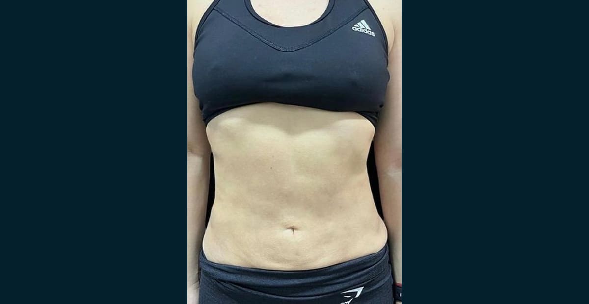 1-despues-bodytite