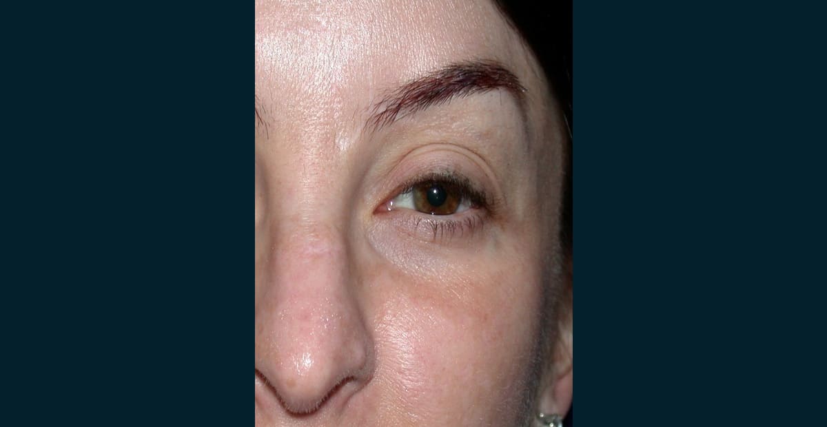 1-despues-clear-skin