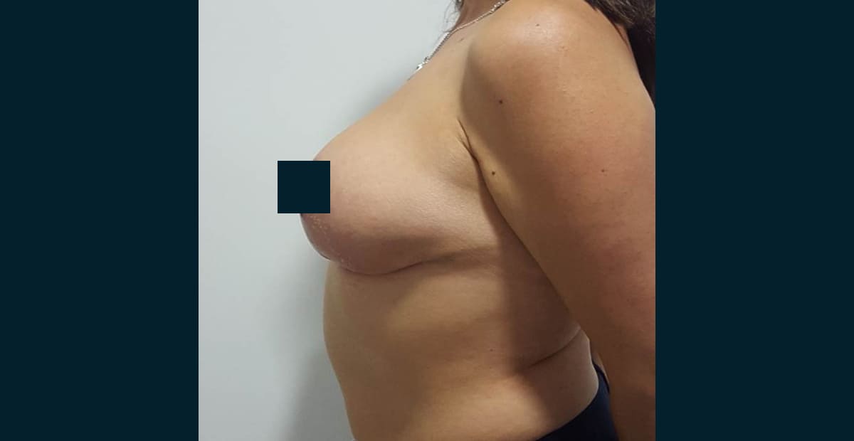 1-despues-mamoplastia-de-reduccion