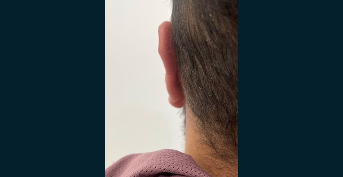 1-despues-otoplastia
