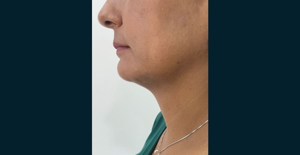 1-despues-perfilado-facial