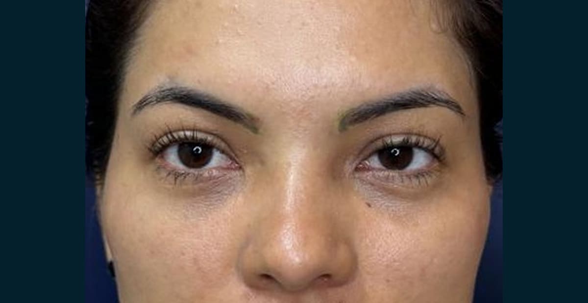1-despues-pexia-de-cejas