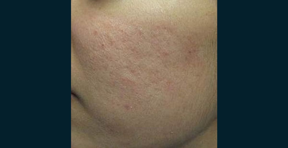 1-despues-secuelas-de-acne