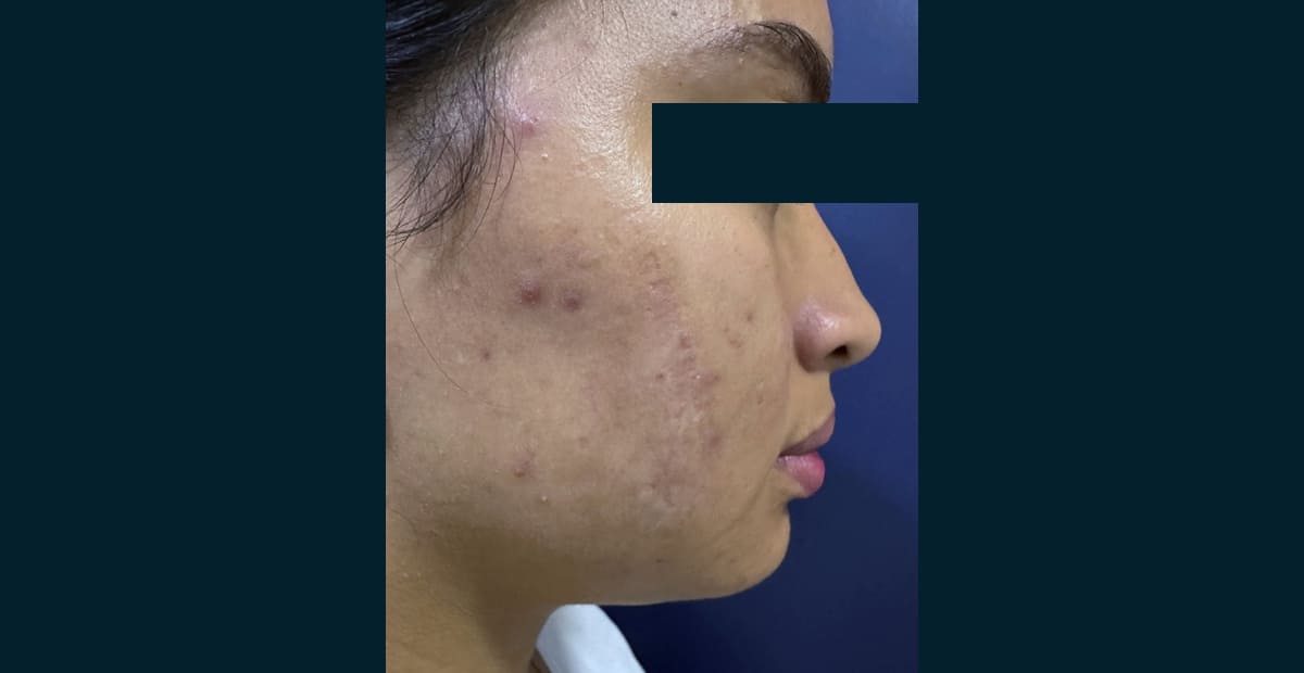 1-despues--tratamiento-de-cicatrices