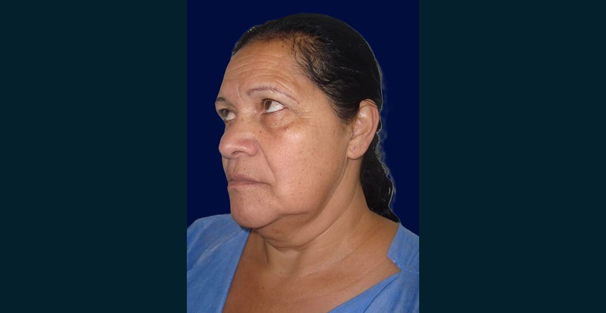 2-antes-Lifting facial