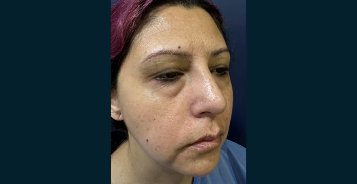 2-antes-bleforoplastia