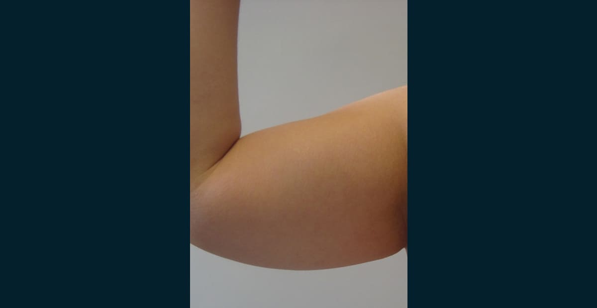 2-antes-brazo-bodytite