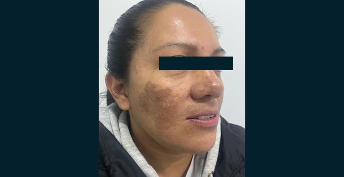 2-antes-clear-skin