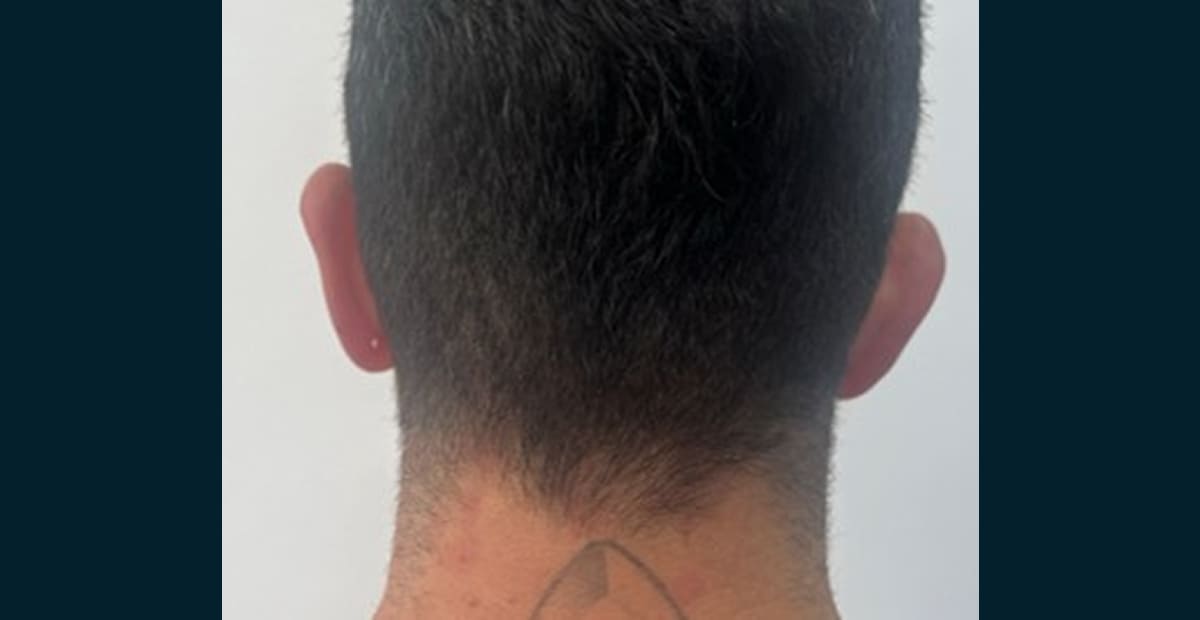 2-antes-otoplastia