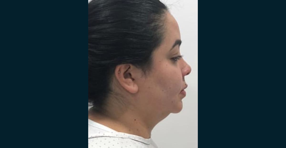 2-antes-perfilado-facial