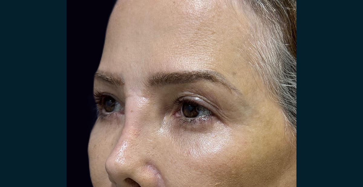2-antes-pexia-de-cejas