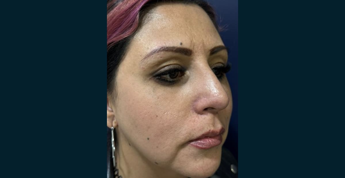 2-despues-bleforoplastia