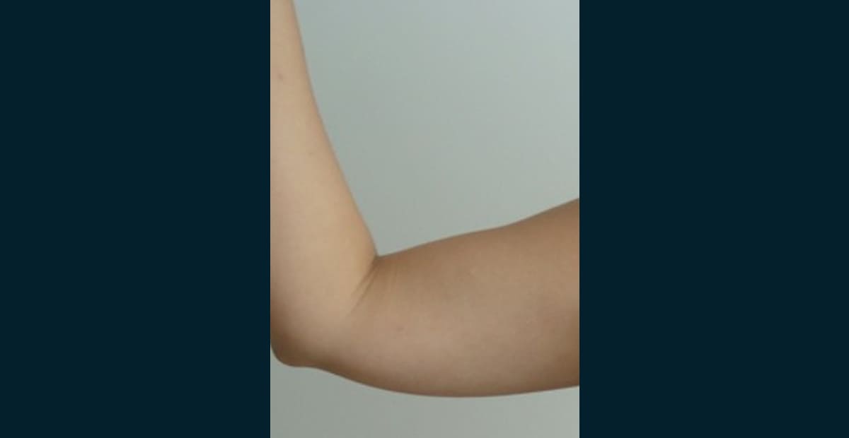 2-despues-brazo-bodytite