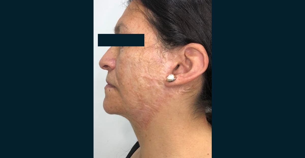 2-despues-cicatrices-por-quemadura