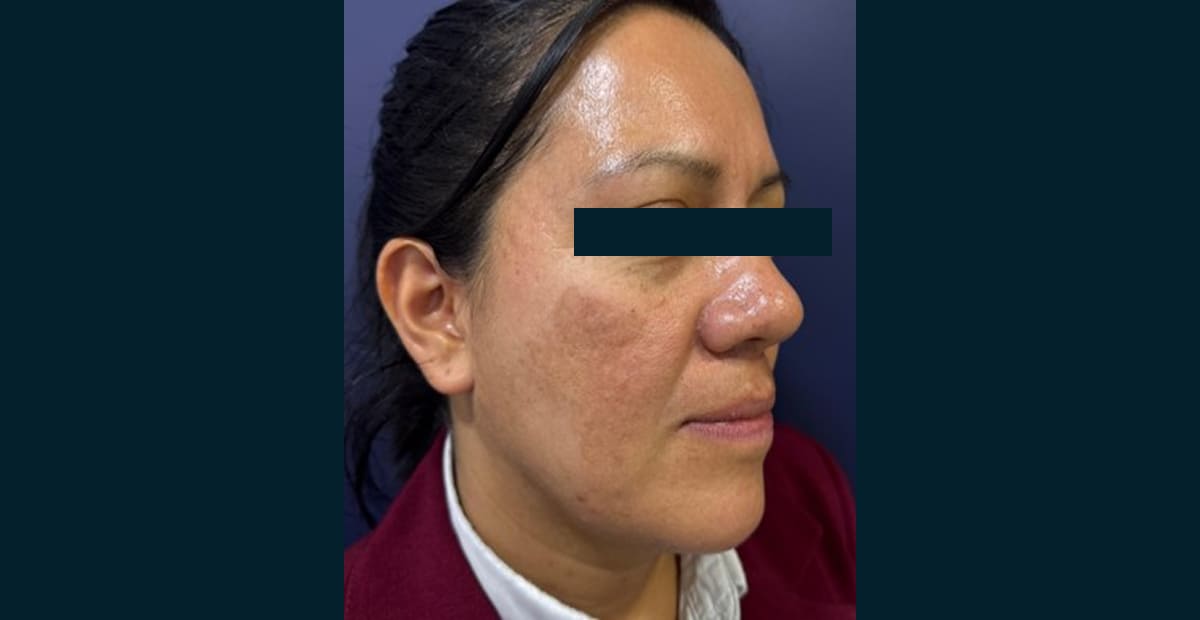2-despues-clear-skin