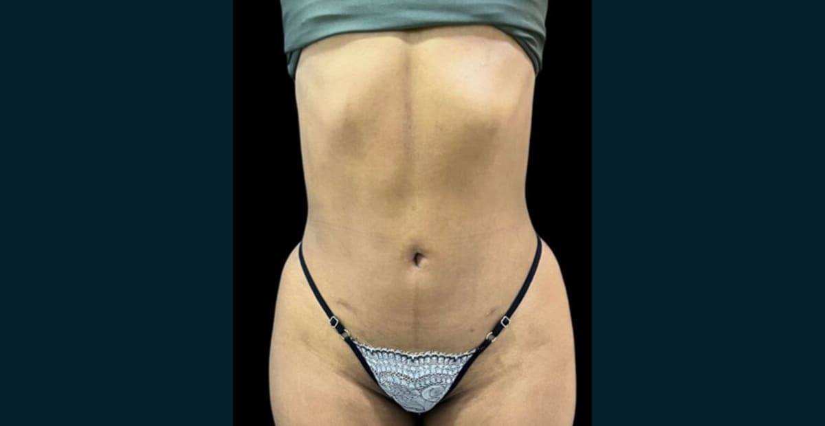 2-despues-liposuccion
