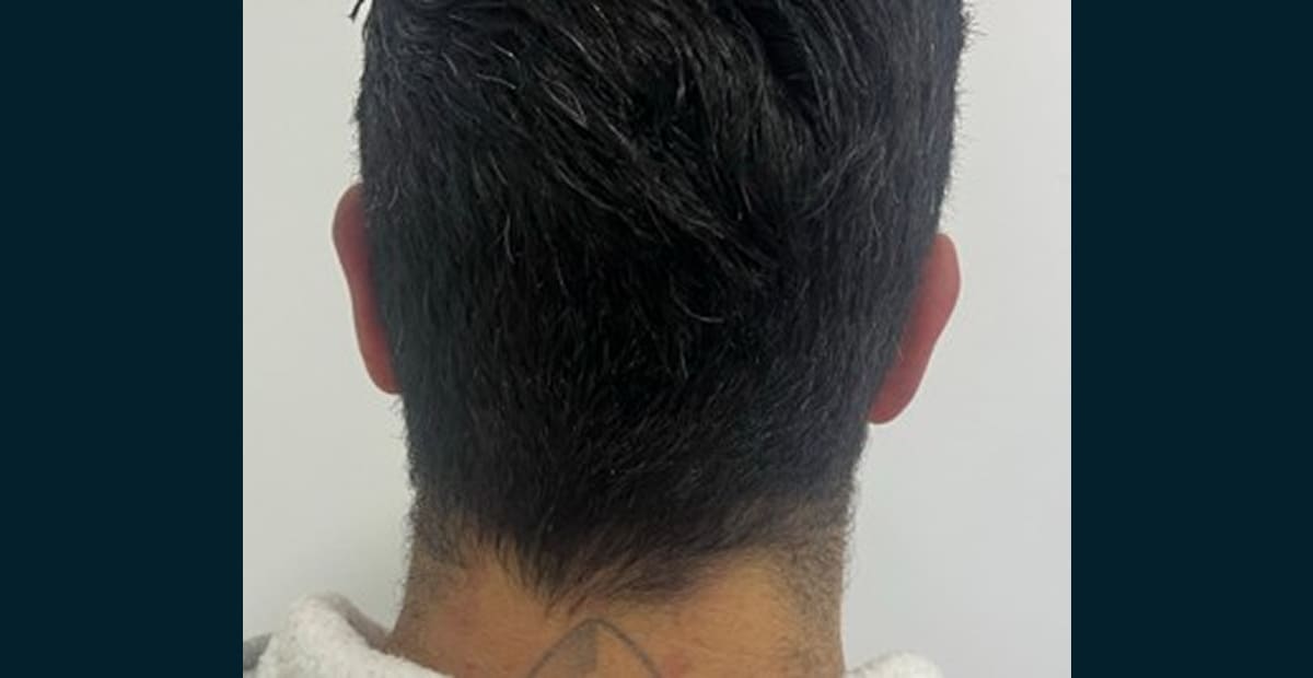 2-despues-otoplastia