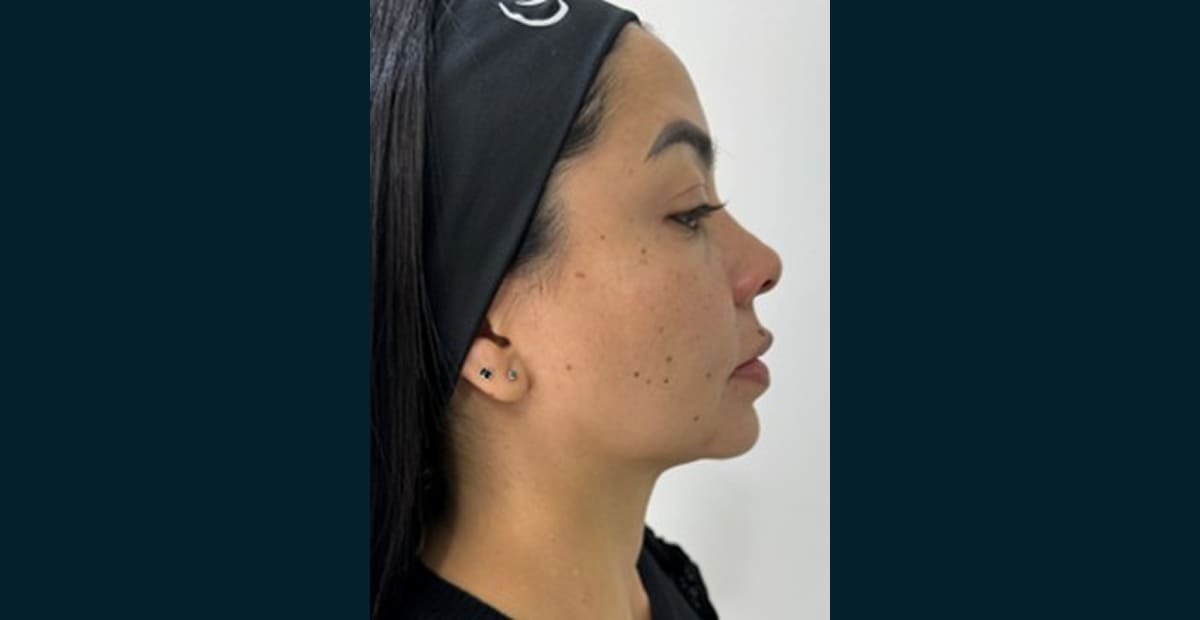 2-despues-perfilado-facial