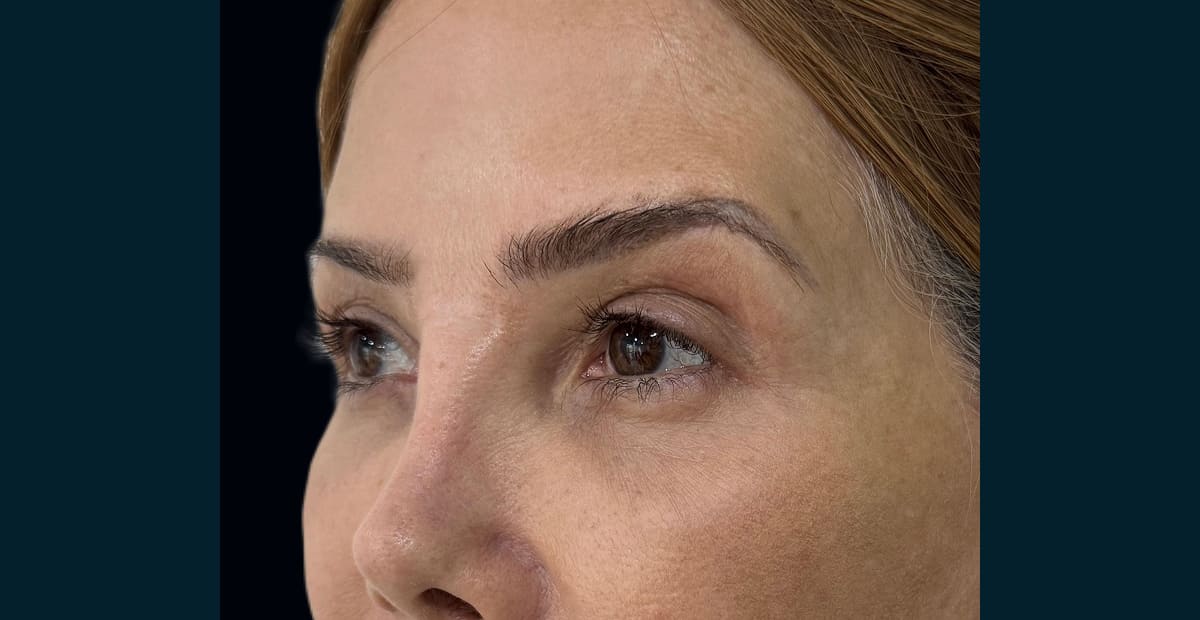 2-despues-pexia-de-cejas