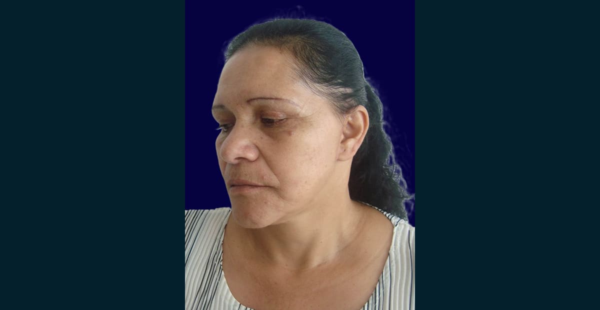 2-despuesLifting facial