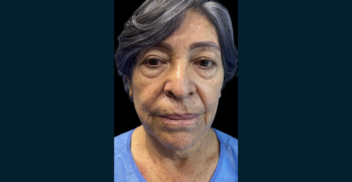 3-antes-Lifting facial