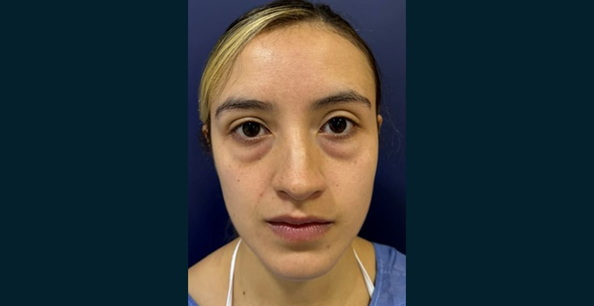 3-antes-bleforoplastia