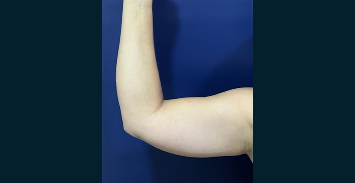 3-antes-brazo-bodytite