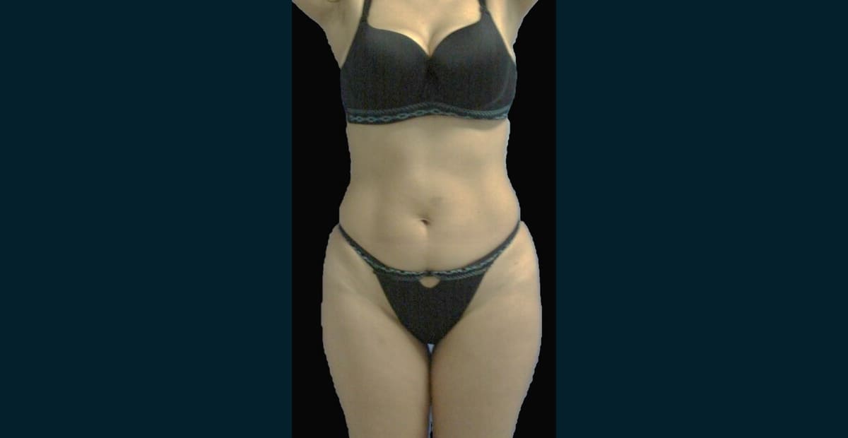 3-antes-liposuccion