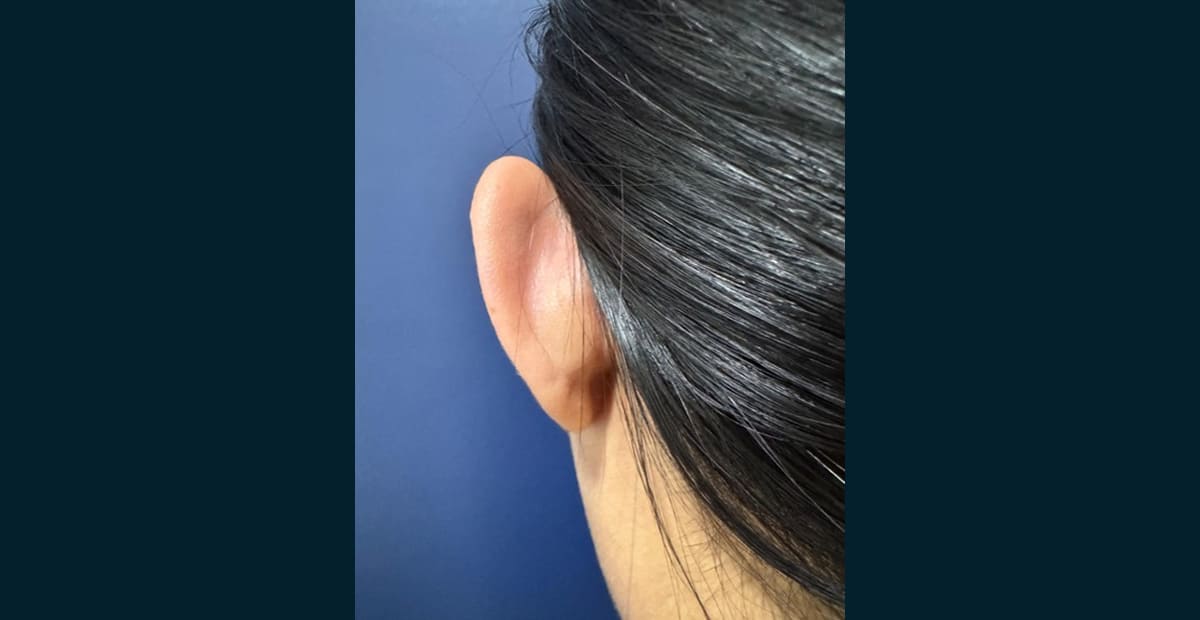 3-antes-otoplastia
