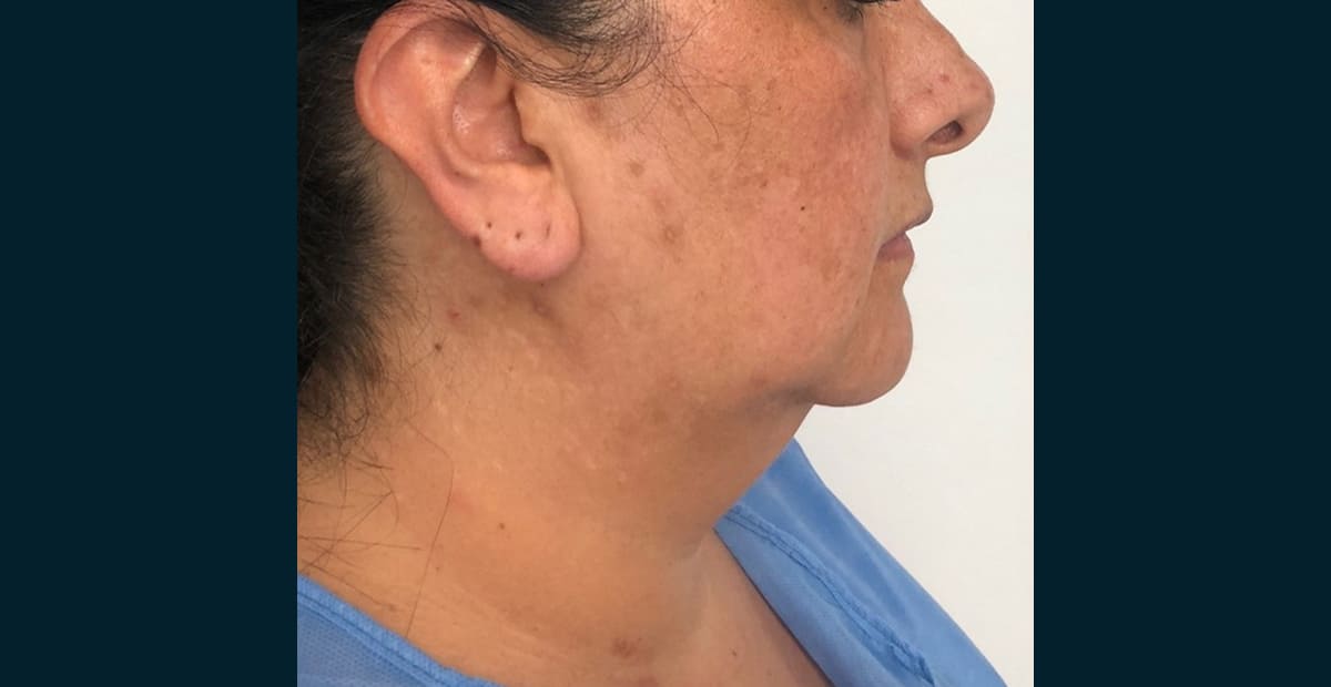 3-antes-perfilado-facial