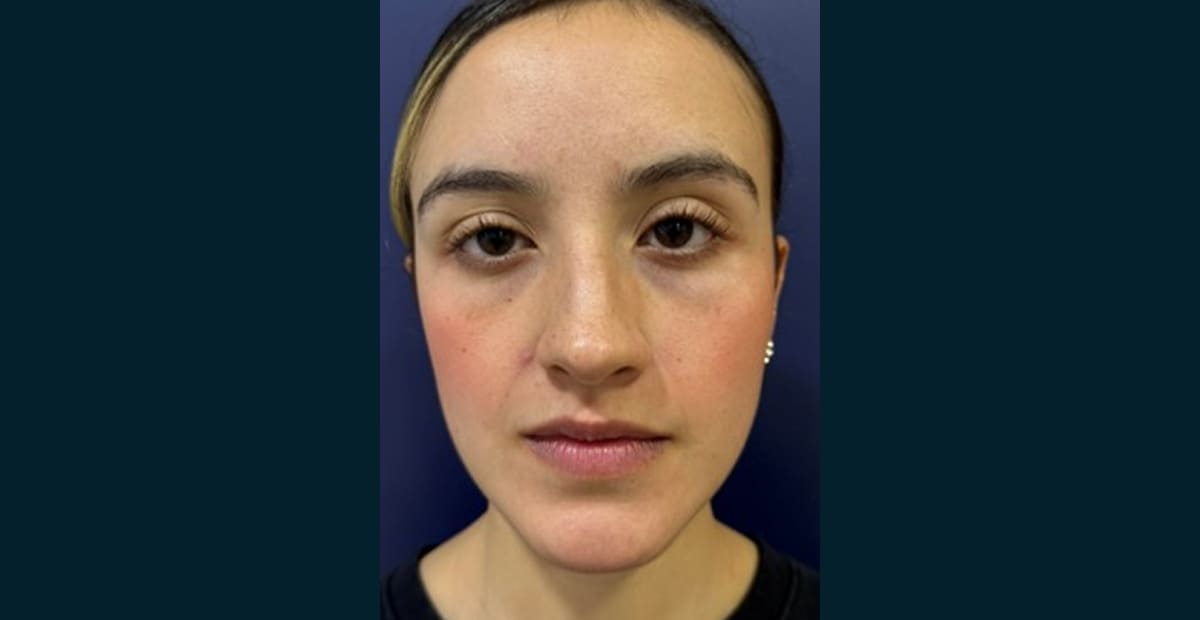 3-despues-bleforoplastia
