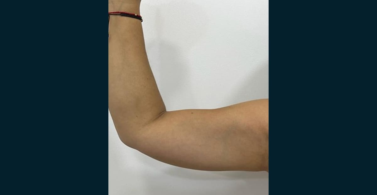 3-despues-brazo-bodytite