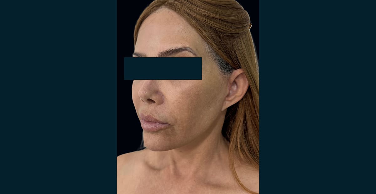 3-despues-minilifting