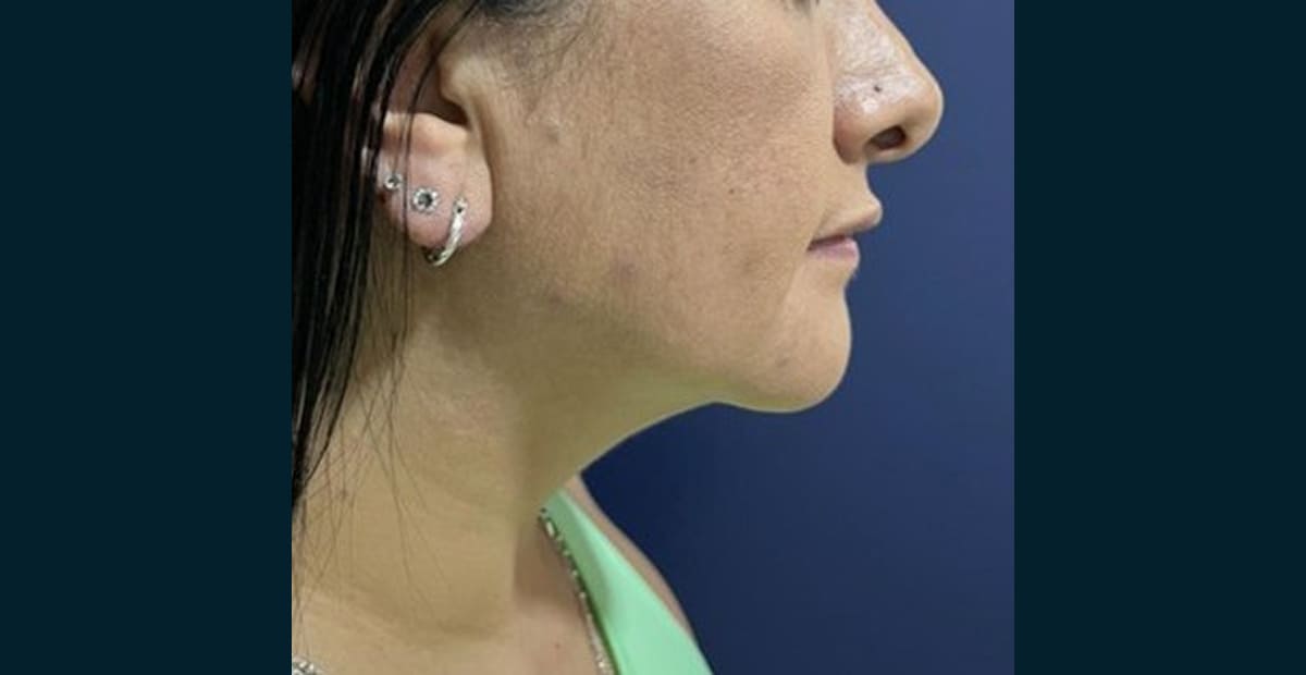 3-despues-perfilado-facial