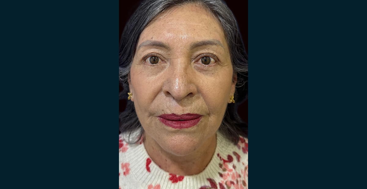 3-despuesLifting facial