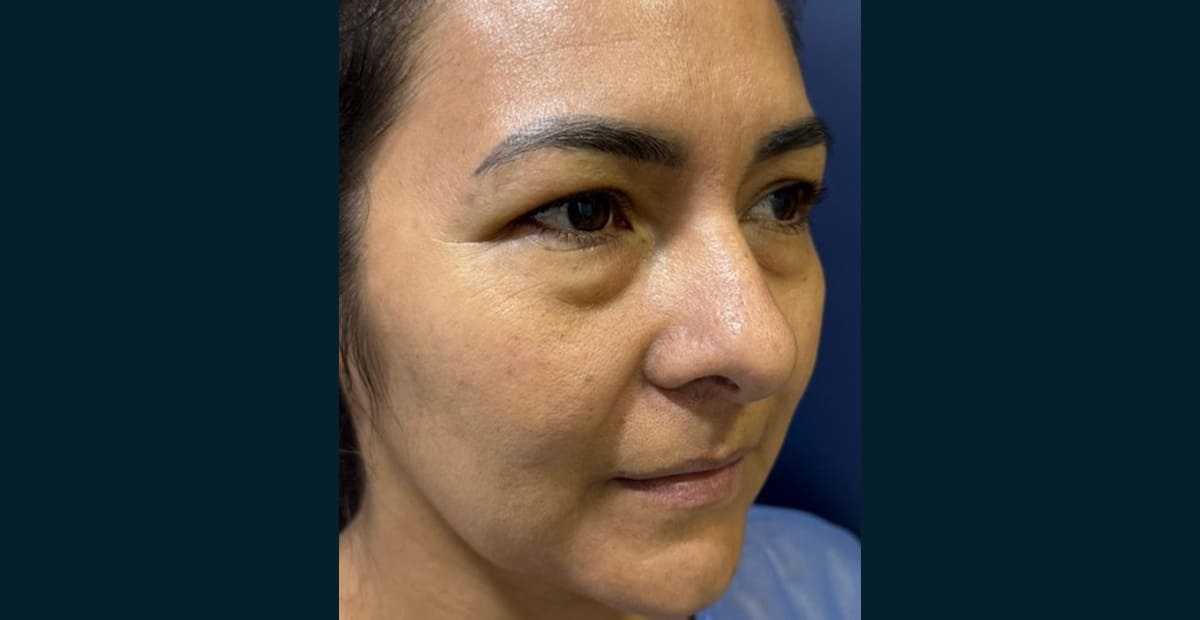 4-antes-bleforoplastia