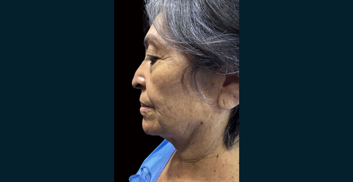 4-antesLifting facial