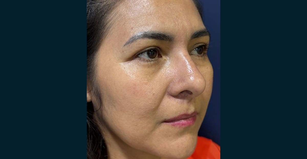 4-despues-bleforoplastia